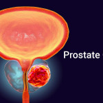 ارتباط سرطان پروستات و رابطه زناشویی، نکات ضروری برای زوجین