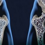 با مصرف این ویتامینها استخوانهای خود را تقویت کنید با مصرف این ویتامینها استخوانهای خود را تقویت کنید