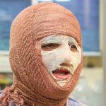 سوختگی در ایران؛ سالی ۳۰۰ هزار سوختگی و زنگ خطر ایمنی