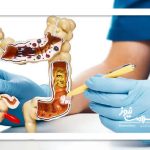 عوامل اصلی رشد سرطانهای گوارشی در ایران،مصرف الکل و دخانیات متهم شماره یک عوامل اصلی رشد سرطانهای گوارشی در ایران،مصرف الکل و دخانیات متهم شماره یک