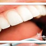 جرمگیری؛ درمانی ساده، بیضرر و کلیدی برای سلامت دهان جرمگیری؛ درمانی ساده، بیضرر و کلیدی برای سلامت دهان