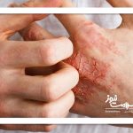 اگزما با این راهکارها درمان میشود اگزما با این راهکارها درمان میشود