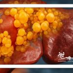 علائمی که نشان دهنده مشکلات کبدی است علائمی که نشان دهنده مشکلات کبدی است