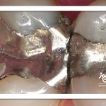 آیا آمالگام سمی است؟ – سلامت نیوز آیا آمالگام سمی است؟ – سلامت نیوز