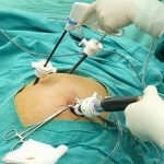 هیستروسکوپی و لاپاراسکوپی زنان؛ درمان ناباروری و موفقیت IVF هیستروسکوپی و لاپاراسکوپی زنان؛ درمان ناباروری و موفقیت IVF