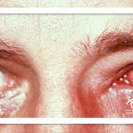 عوارض آلودگی هوا بر چشم عوارض آلودگی هوا بر چشم