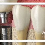 حقایقی درباره ایمپلنتهای یک روزه حقایقی درباره ایمپلنتهای یک روزه