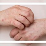 آلودگی هوا و تأثیر مخفی آن بر پوست: پیری زودرس و التهاب در کمین