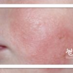 احتمال ابتلای نوزادن به این عوارض پوستی وجود دارد