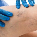 برطرف کردن قطعی و سریع واریس پا در خانه امکان پذیر است؟ برطرف کردن قطعی و سریع واریس پا در خانه امکان پذیر است؟