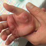 چرا سوختگی در کودکان به مراتب خطرناک‌تر از بزرگسالان است؟