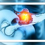 گامی بزرگ در درمان یکی از مرگبارترین سرطان‌ها