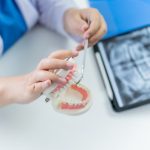 پیش از شروع کاشت ایمپلنت اقساطی در غرب تهران چه نکاتی را باید بدانیم