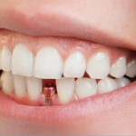 هزینه ایمپلنت دندان تهران 1404 + قیمت ایمپلنت با بیمه