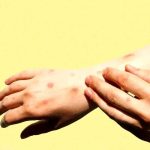 شناسایی هزار و ۱۰۷ بیمار مبتلا به تب دنگی در کشور / کدام استانها درگیر این بیماری هستند؟ شناسایی هزار و ۱۰۷ بیمار مبتلا به تب دنگی در کشور / کدام استانها درگیر این بیماری هستند؟