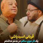 قربانی اسیدپاشی : یک تار موی سالم در بدنم نداشتم + فیلم قربانی اسیدپاشی : یک تار موی سالم در بدنم نداشتم + فیلم