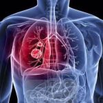 اهمیت حیاتی تشخیص زودهنگام و مراجعه به موقع: راهکاری کلیدی برای پیشگیری از عوارض تودهها اهمیت حیاتی تشخیص زودهنگام و مراجعه به موقع: راهکاری کلیدی برای پیشگیری از عوارض تودهها