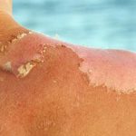 هشدار جدی: سولاریوم و برنزه کردن پوست، افزایش سه برابری خطر مرگبارترین سرطان پوست هشدار جدی: سولاریوم و برنزه کردن پوست، افزایش سه برابری خطر مرگبارترین سرطان پوست